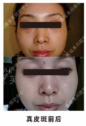 祛斑之后也不能掉以輕心，成都神奇魔斑告訴您有這些注意事項